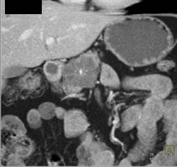 Cystadenoma - CTisus CT Scan