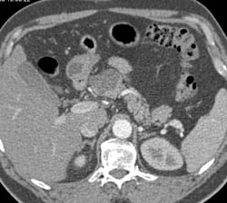 Cystadenoma - CTisus CT Scan