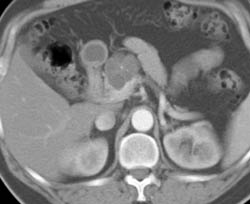 Cystadenoma - CTisus CT Scan