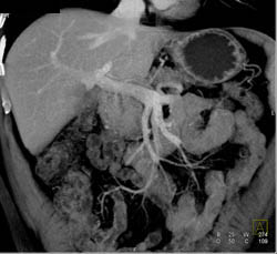 Lymphoma Infiltrates the Zone Around the Mesenteric Vessels and No Pancreatic Primary - CTisus CT Scan