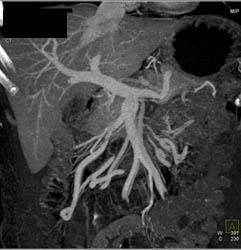 Pancreatic Cancer Obstructs the Duodenum at the Ligament of Treitz - CTisus CT Scan