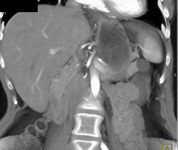 Cystadenoma - CTisus CT Scan