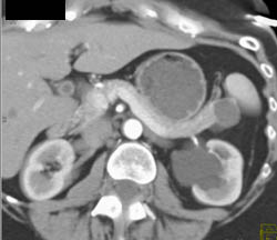 Cystadenoma - CTisus CT Scan