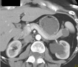 Cystadenoma - CTisus CT Scan