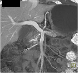 Chronic Pancreatitis - CTisus CT Scan