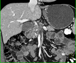 Chronic Pancreatitis - CTisus CT Scan