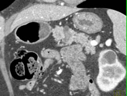 Intraductal Papillary Mucinous Neoplasm (IPMN) - CTisus CT Scan