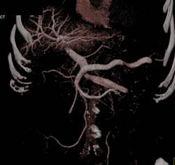 Intraductal Papillary Mucinous Neoplasm (IPMN) - CTisus CT Scan