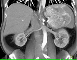 Islet Cell Tumor With Liver Metastases - CTisus CT Scan