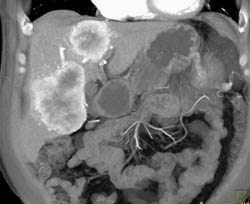 Islet Cell Tumor With Liver Metastases - CTisus CT Scan