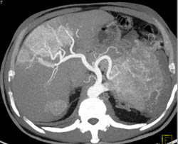 Islet Cell Tumor With Liver Metastases - CTisus CT Scan