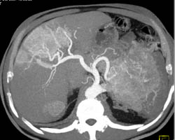 Islet Cell Tumor With Liver Metastases - CTisus CT Scan