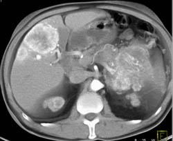 Islet Cell Tumor With Liver Metastases - CTisus CT Scan