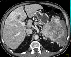 Islet Cell Tumor With Liver Metastases - CTisus CT Scan