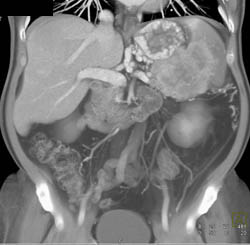 Islet Cell Tumor With Liver Metastases - CTisus CT Scan