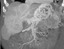 Islet Cell Tumor With Liver Metastases - CTisus CT Scan