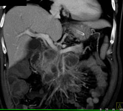 Pancreatic Cancer Occludes the PV/SMV - CTisus CT Scan