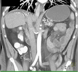 Patent Hepatic Artery - CTisus CT Scan