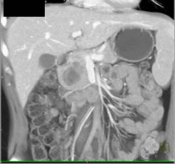 Hamoudi Tumor- SPEN - CTisus CT Scan