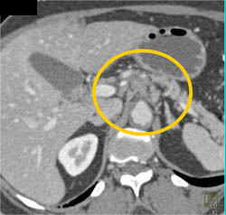 Subtle Tumor of Body of the Pancreas Encases the SMA and Aorta - CTisus CT Scan