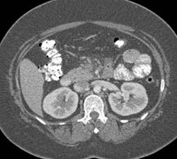 Superior Mesenteric Vein (SMV) Clot Due to Pancreatitis - CTisus CT Scan