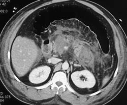 Acute Pancreatitis With Pancreatic Necrosis - CTisus CT Scan