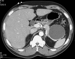 Pseudocyst - CTisus CT Scan