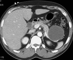 Pseudocyst - CTisus CT Scan