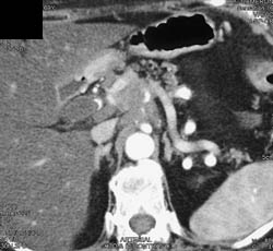 Pancreatic Cancer Encases the Celiac and SMA - CTisus CT Scan