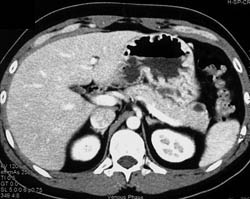 Intraductal Papillary Mucinous Neoplasm (IPMN) in Tail of Pancreas - CTisus CT Scan