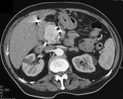 Hepatic Artery Aneurysm - CTisus CT Scan