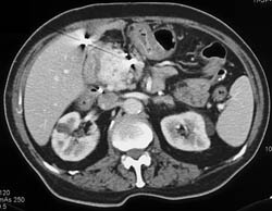 Hepatic Artery Aneurysm - CTisus CT Scan