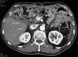 Post Whipple Pancreatic Bed - CTisus CT Scan