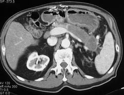 Carcinoma of the Body and Tail of the Pancreas - CTisus CT Scan