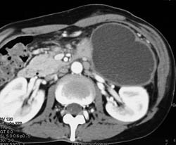 Pseudocyst With Septations - CTisus CT Scan