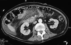 Acute Pancreatitis - CTisus CT Scan