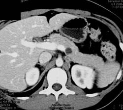 Intraductal Papillary Mucinous Neoplasm (IPMN) - CTisus CT Scan