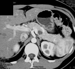 Intraductal Papillary Mucinous Neoplasm (IPMN) - CTisus CT Scan