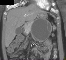 Pancreatic Pseudocyst - CTisus CT Scan