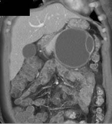 Pseudocyst With Septation - CTisus CT Scan