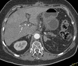 Tumor Encases the Hepatic Artery - CTisus CT Scan