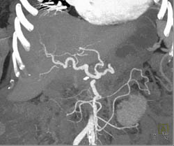 Clot in PV/SMV Due to Tumor - CTisus CT Scan