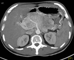 Islet Cell Tumor With Cavernous Transformation of the Portal Vein (CTPV) and Splenic Vein Occlusion - CTisus CT Scan