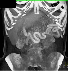 Tumor Also Invades the Portal Vein (PV) With Collaterals - CTisus CT Scan