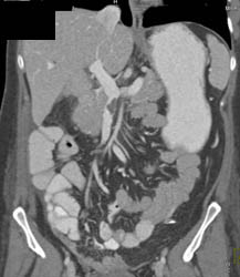 Partial Superior Mesenteric Vein (SMV) Occlusion By Thrombus - CTisus CT Scan