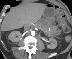 Pancreatic Cystadenoma - CTisus CT Scan