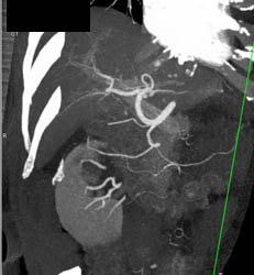 Chronic Pancreatitis - CTisus CT Scan