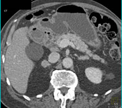 Chronic Pancreatitis - CTisus CT Scan