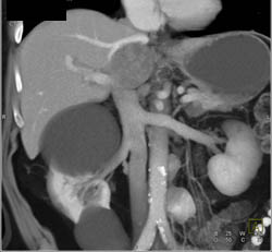 Neuroendocrine Tumor With Nodes Near IVC - CTisus CT Scan