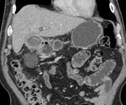 Ampullary Mass With Thickened Gallbladder - CTisus CT Scan